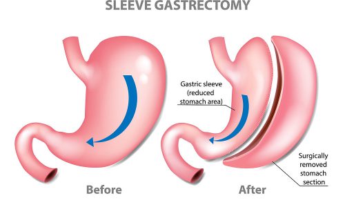 sleeve-gastectomy